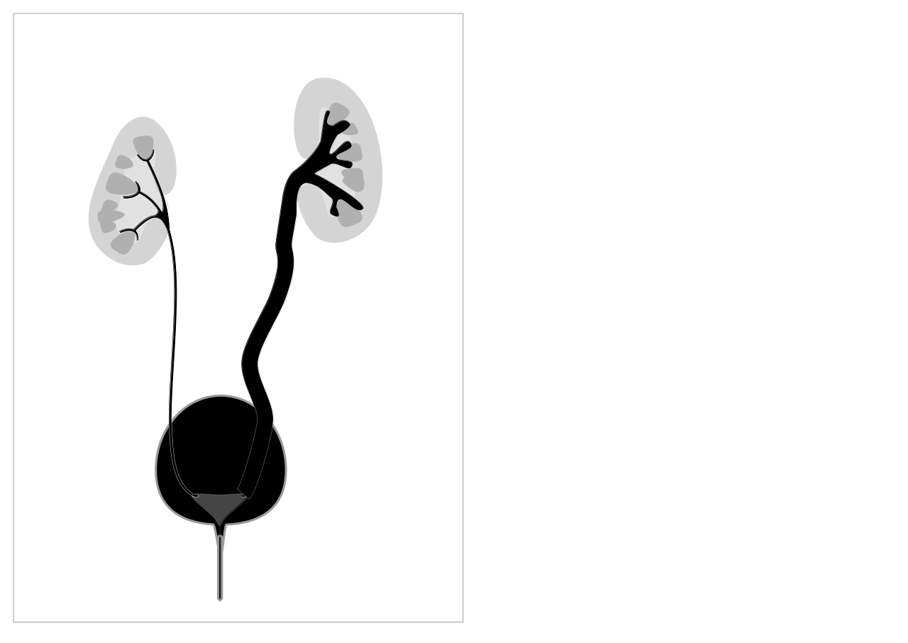 RVU grade IV : dilatation pyélocalicielle franche