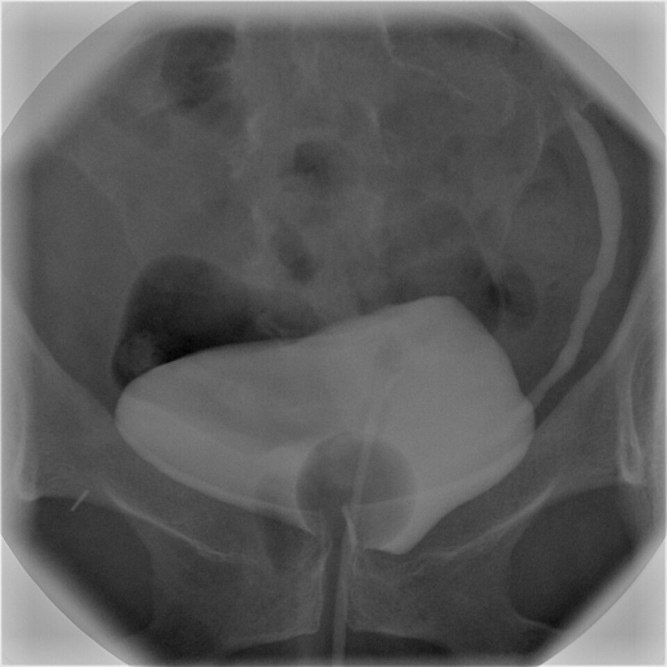 Cystographie rétrograde