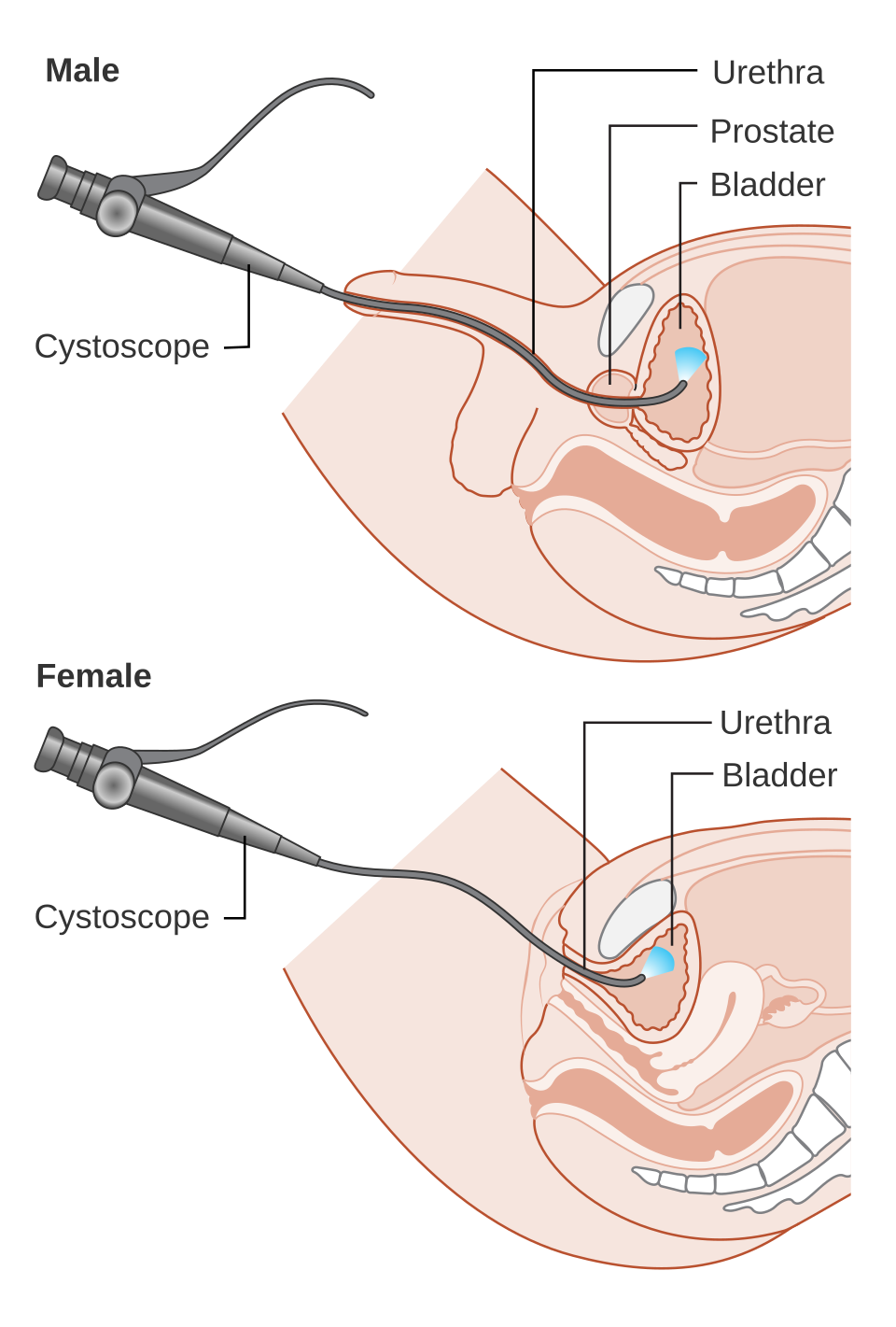 Cystoscopie