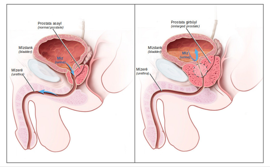 Hypertrophie bénigne de prostate