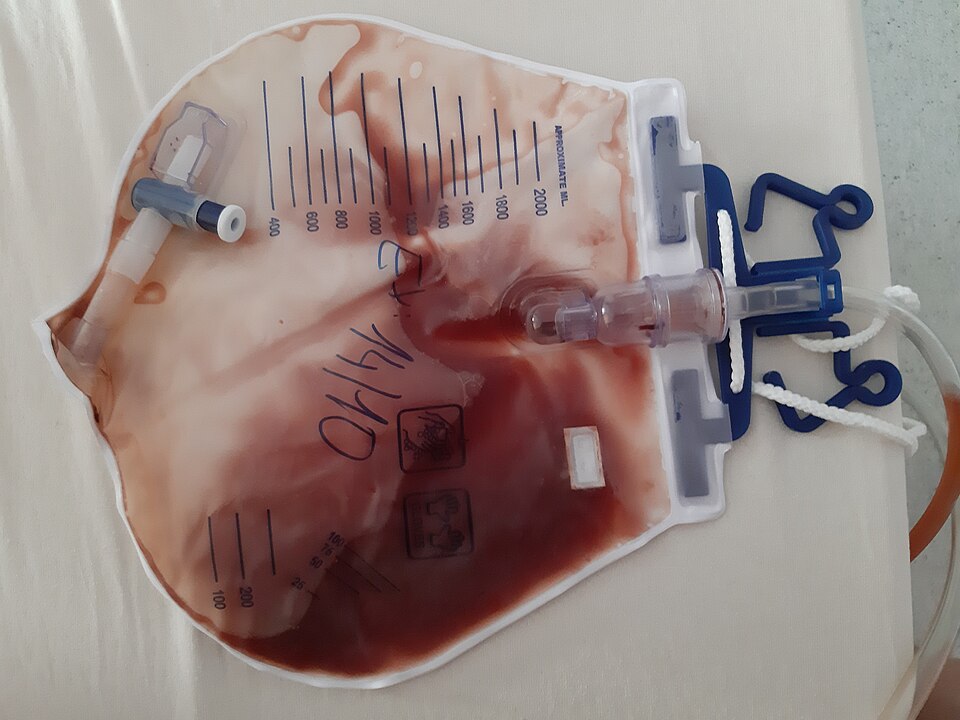 Hématurie macroscopique avec caillotage