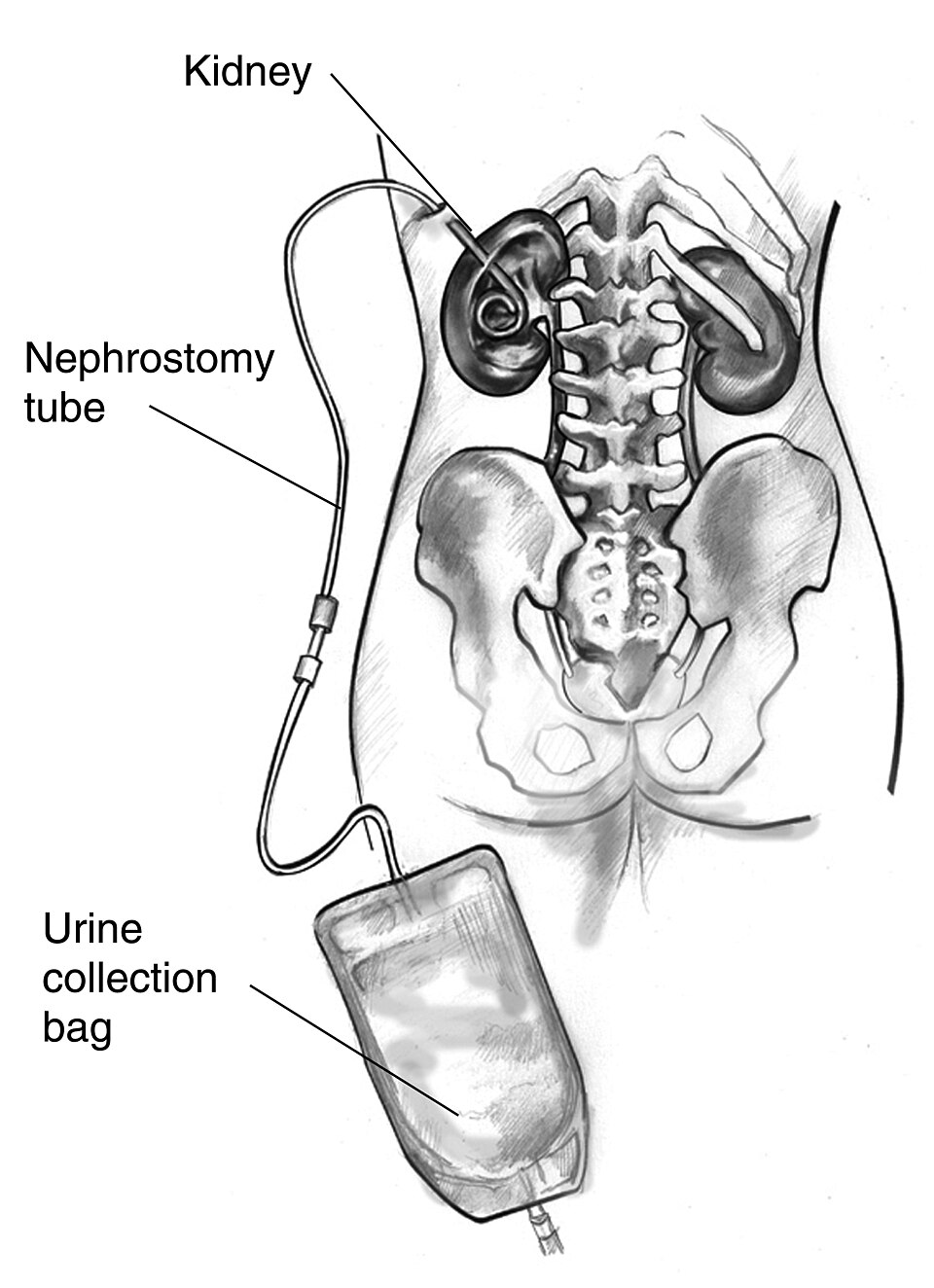 Néphrostomie percutanée