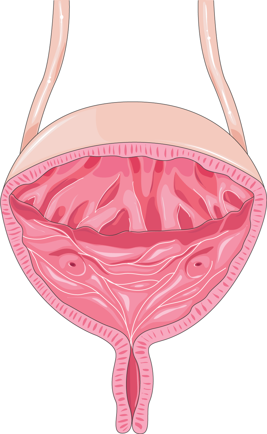 Rétention aiguë d'urine