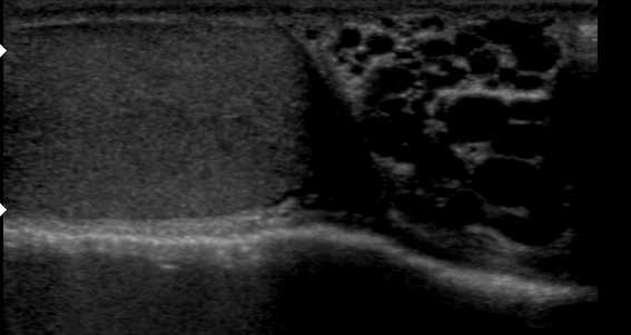 Varicocèle