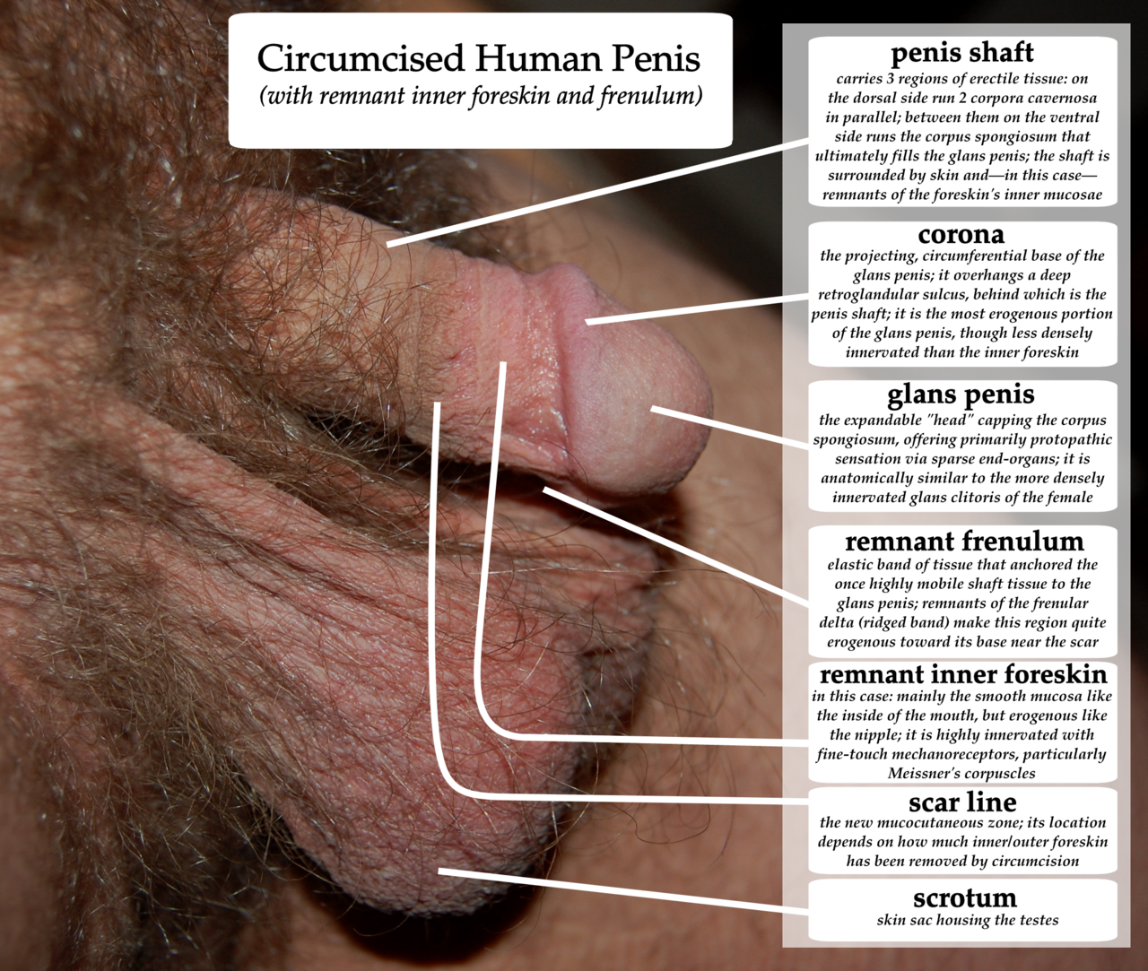 A diagram of a circumcised human penis with remnant inner fo
