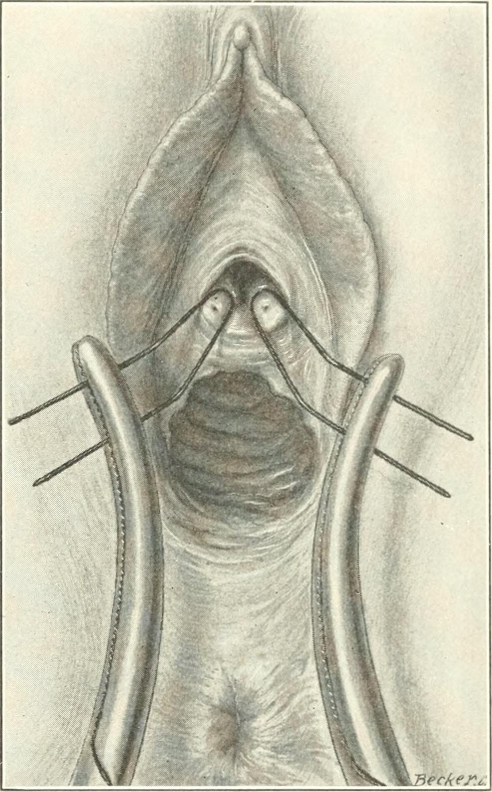 Skene s glands identifier diseasesofkidney01kell find matche