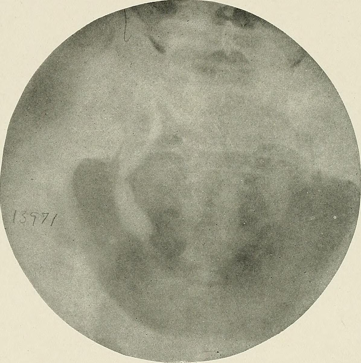 Identifier pyelographypyelo00braa find matches title pyelogr