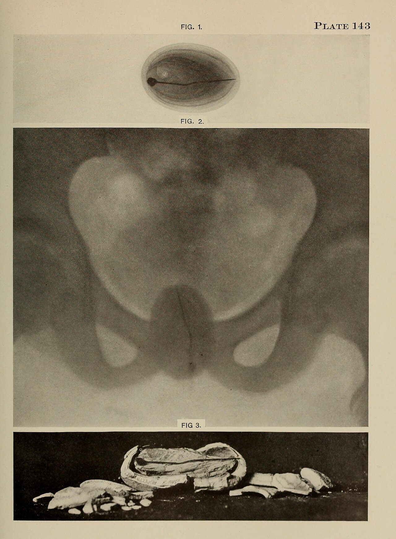 Stone in urethra encapsulating a pin girl 13 years old upper