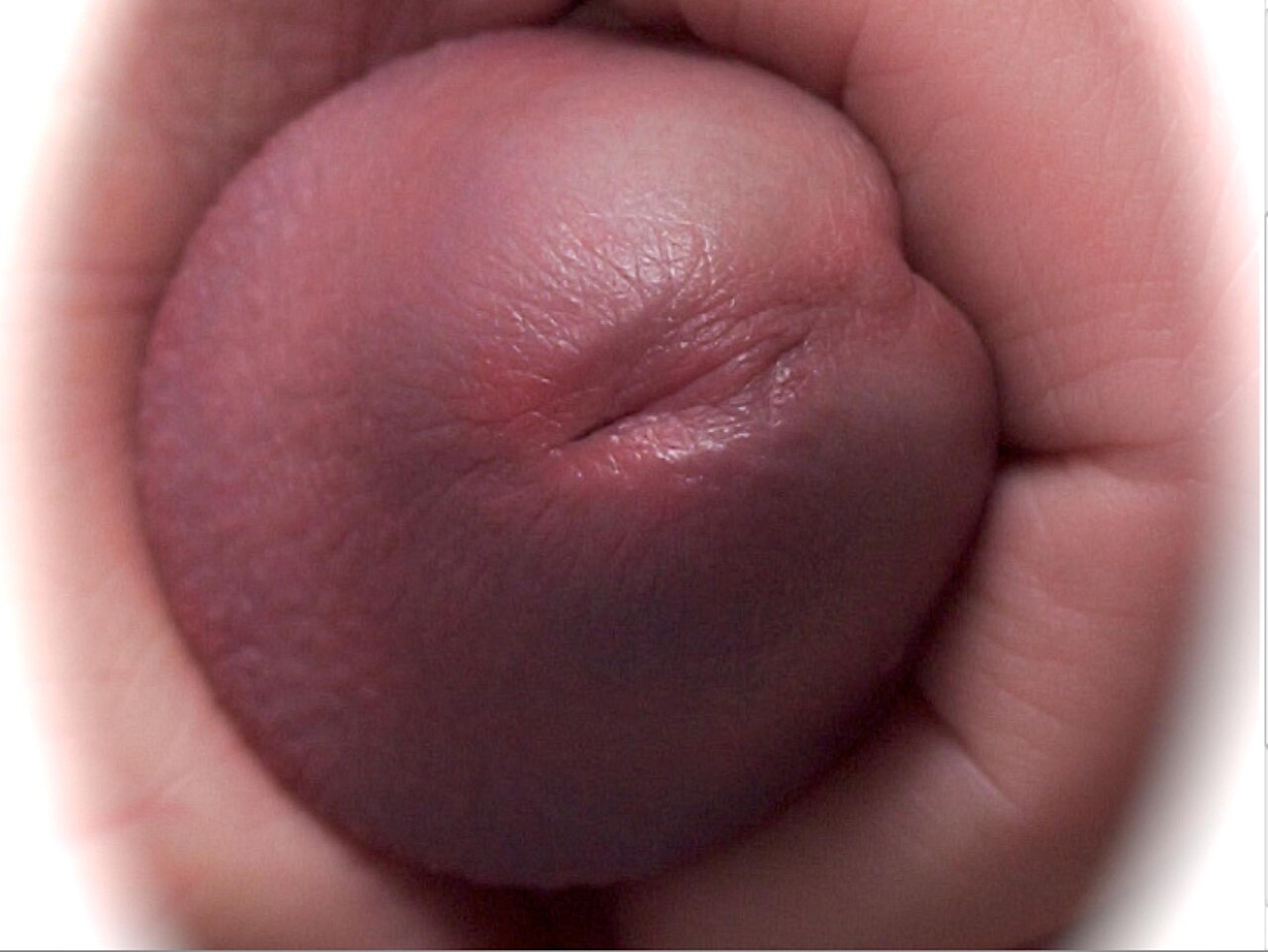 Male urethral meatus at the tip of the glans penis