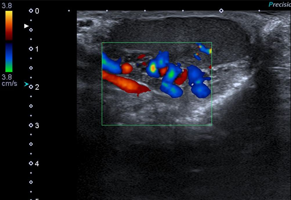 Left testicular seminoma varicocele ultrasound image