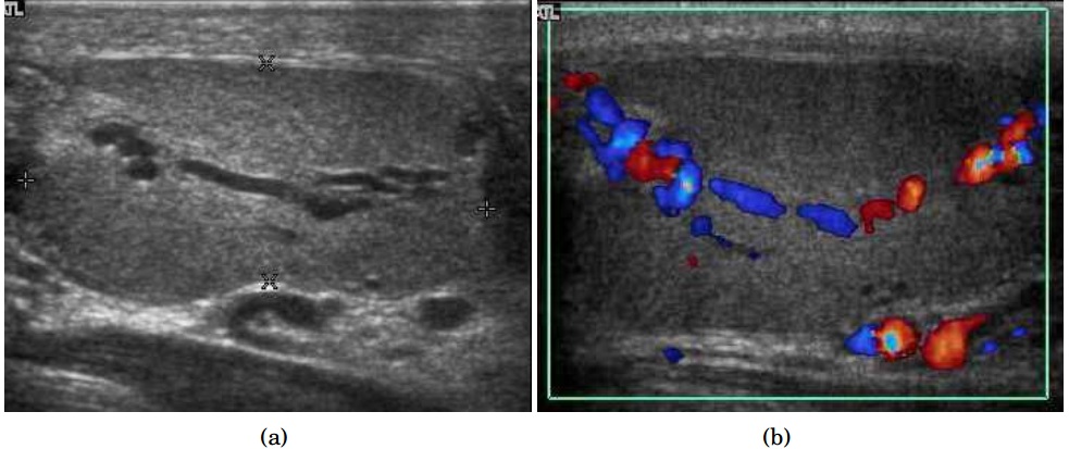 Scrotal ultrasonography of an intratesticular varicocele
