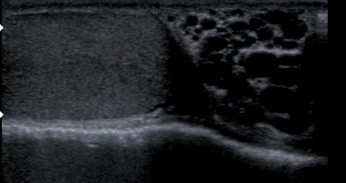 Varicocele and testis in ultrasound transverse image