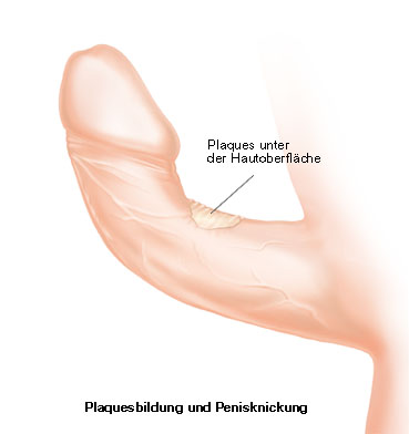 Peyronie s disease nodules so called plaques under the skin
