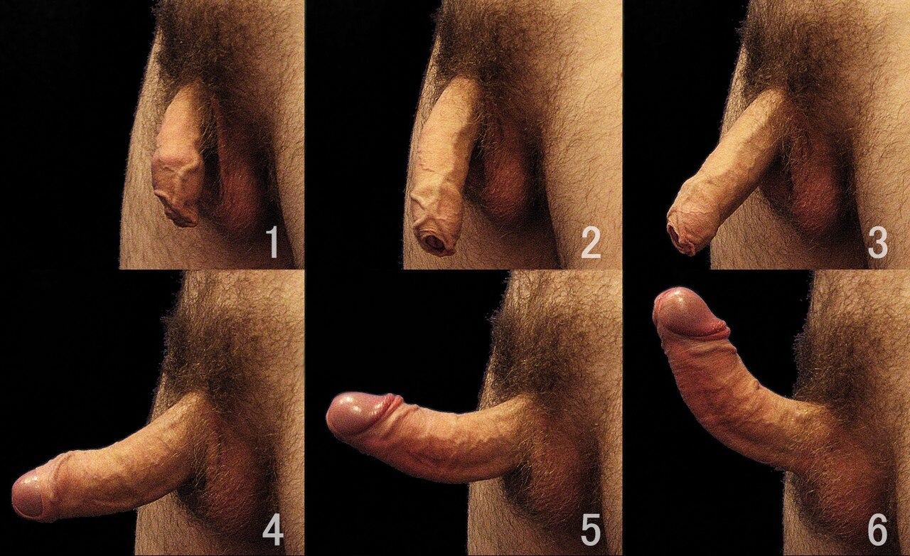 Erection development of a penis exhibiting signs of peyronie