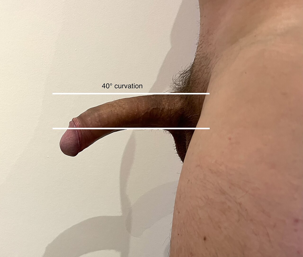 Peyronie s disease curved penis penis curvature penis deform