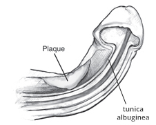 Peyronie s disease