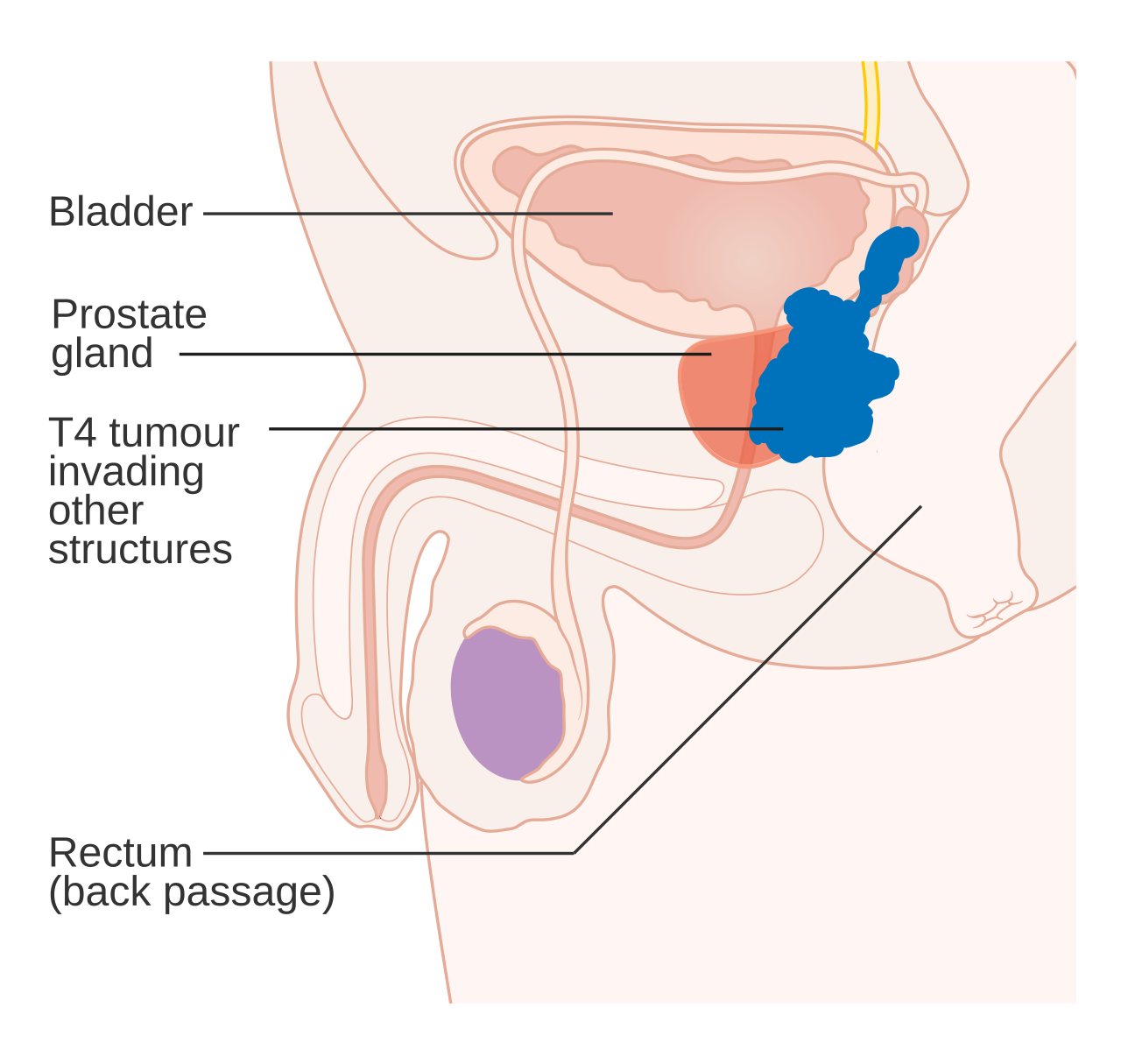 Diagram showing stage t4 prostate cancer