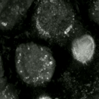 Human prostate cancer cells undergoing ferroptosis captured