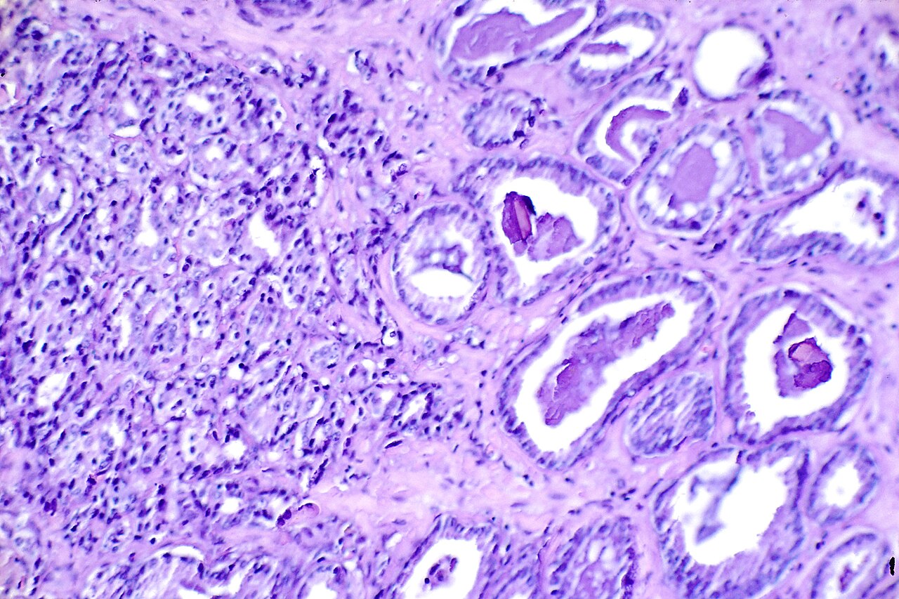 Title prostate cancer description histological slide h amp e