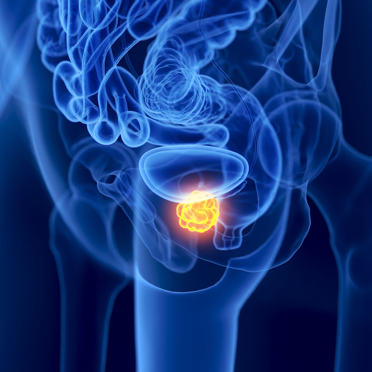 A lateral x ray view of prostate cancer