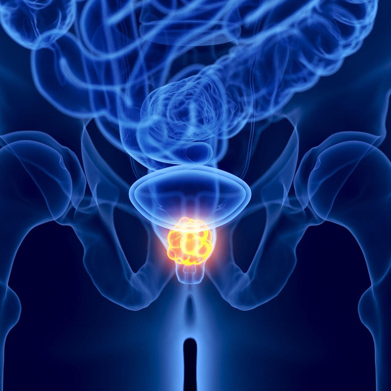 Anterior x ray view of prostate cancer