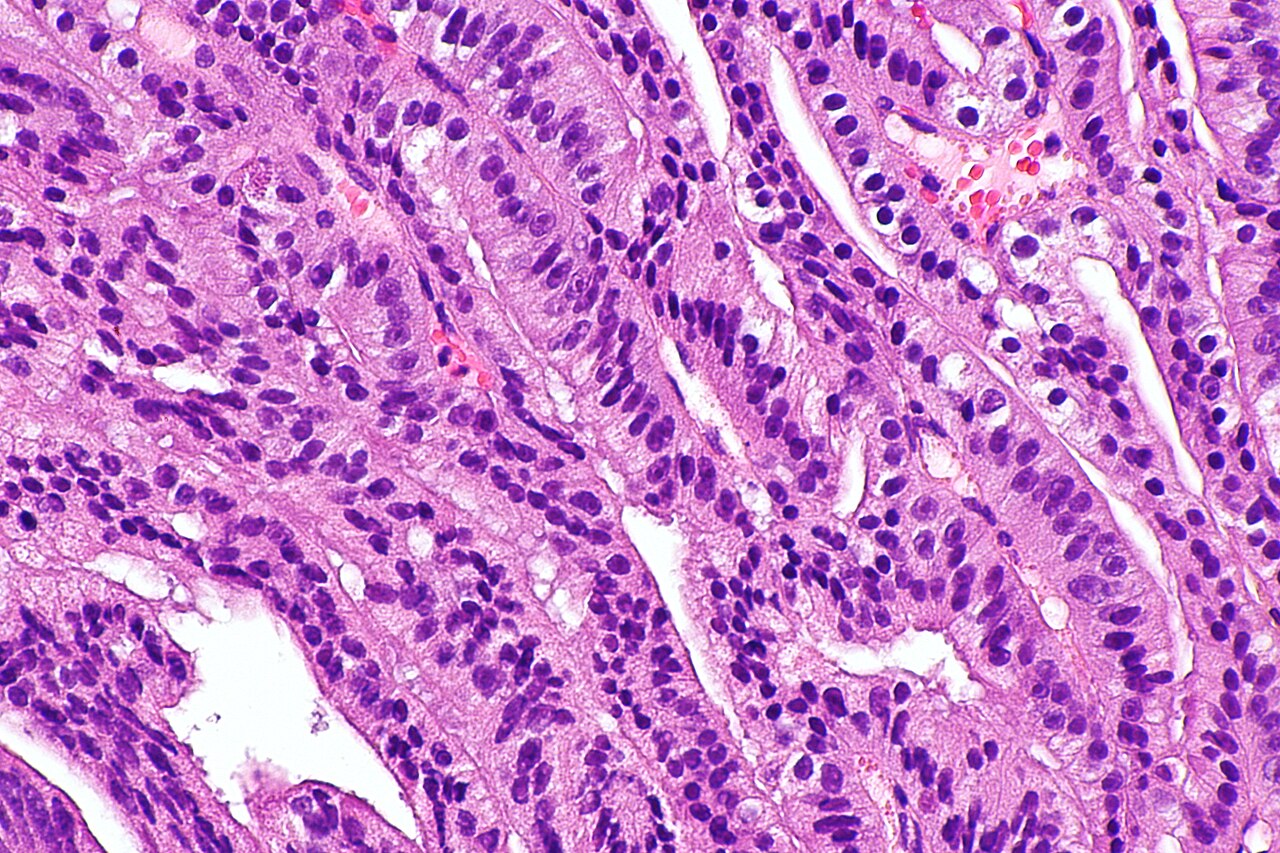 Micrograph showing ductal adenocarcinoma of the prostate gla
