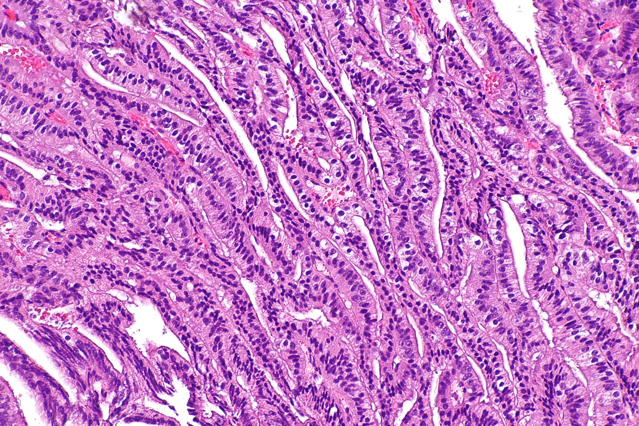 Micrograph showing ductal adenocarcinoma of the prostate gla