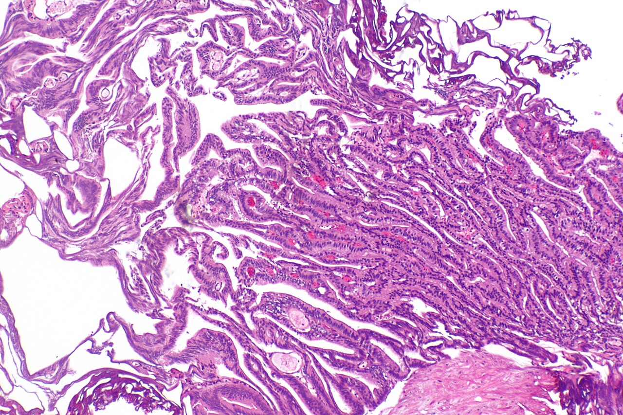 Micrograph showing ductal adenocarcinoma of the prostate gla