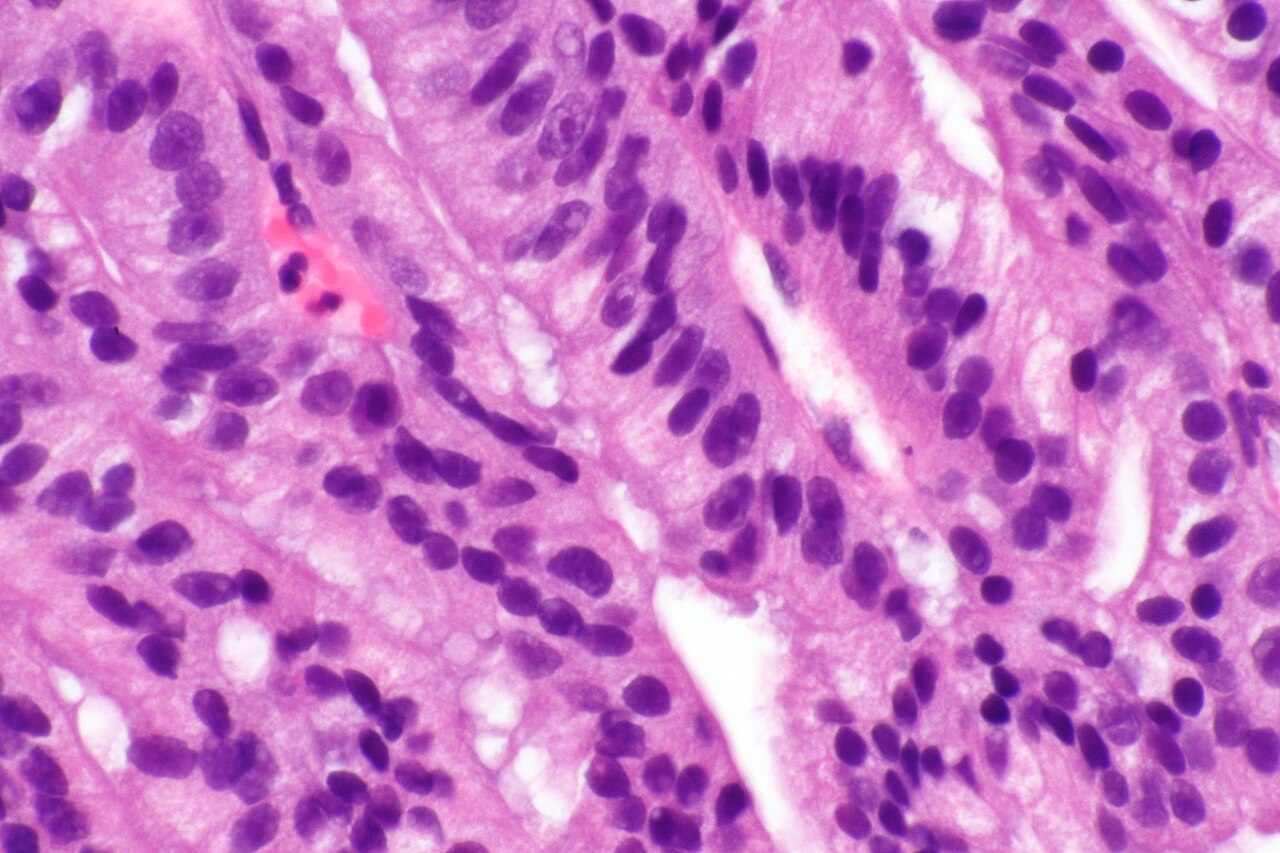 Micrograph showing ductal adenocarcinoma of the prostate gla