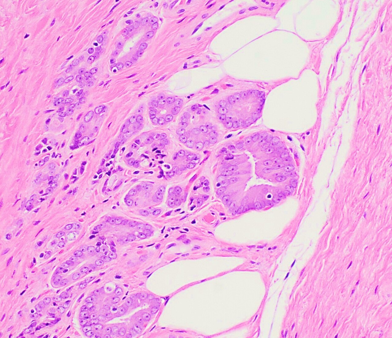 Histopathology of prostate adenocarcinoma involving adipose
