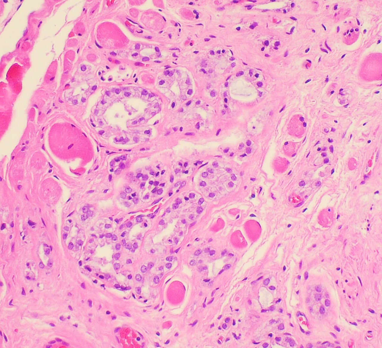 Histopathology of prostate adenocarcinoma involving skeletal