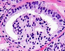 Micrograph of prostate adenocarcinoma with a glomeruloid gla