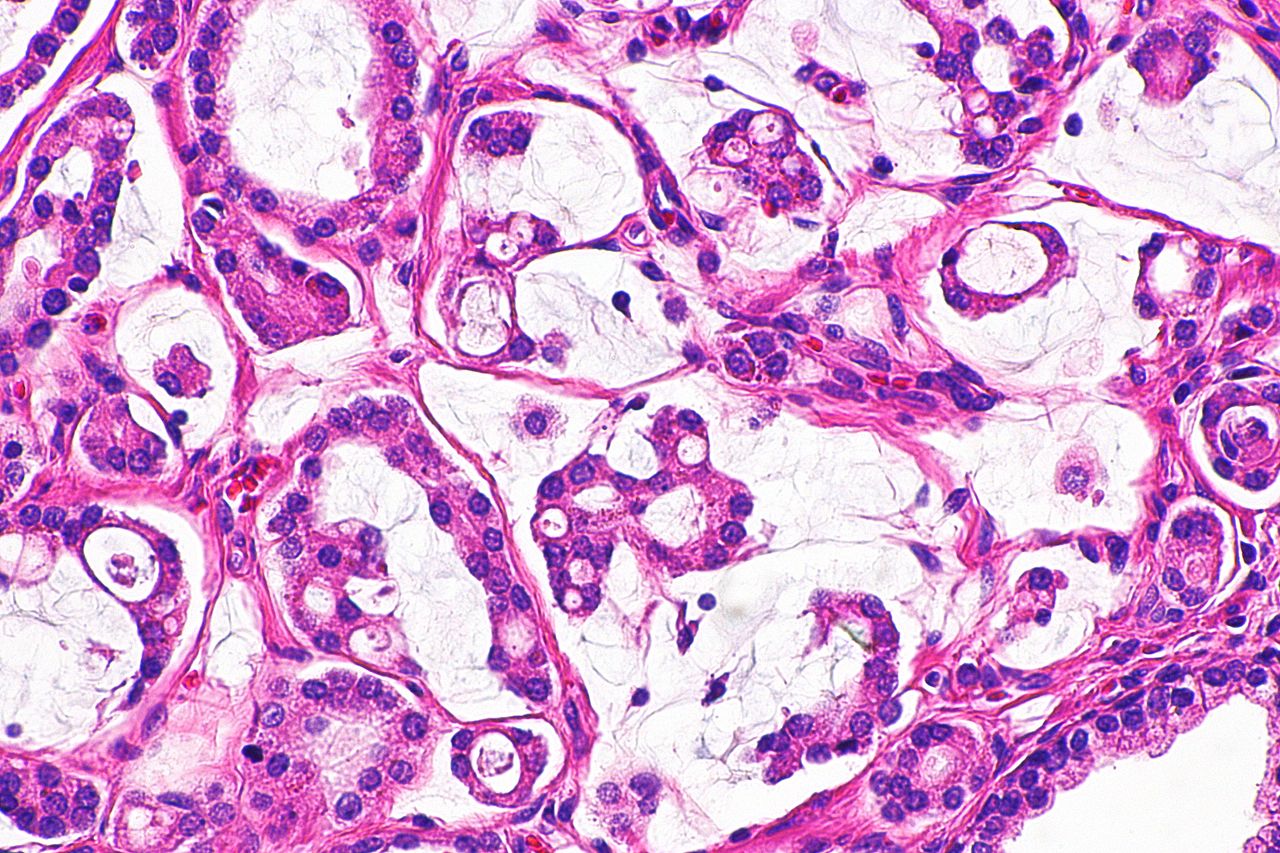 Micrograph showing mucinous adenocarcinoma of the prostate h