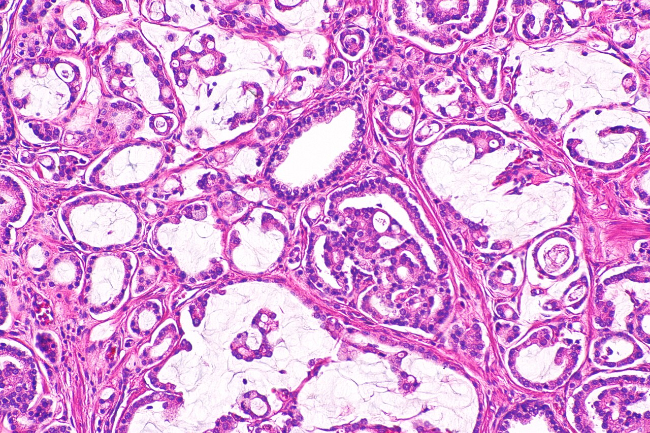 Micrograph showing mucinous adenocarcinoma of the prostate h