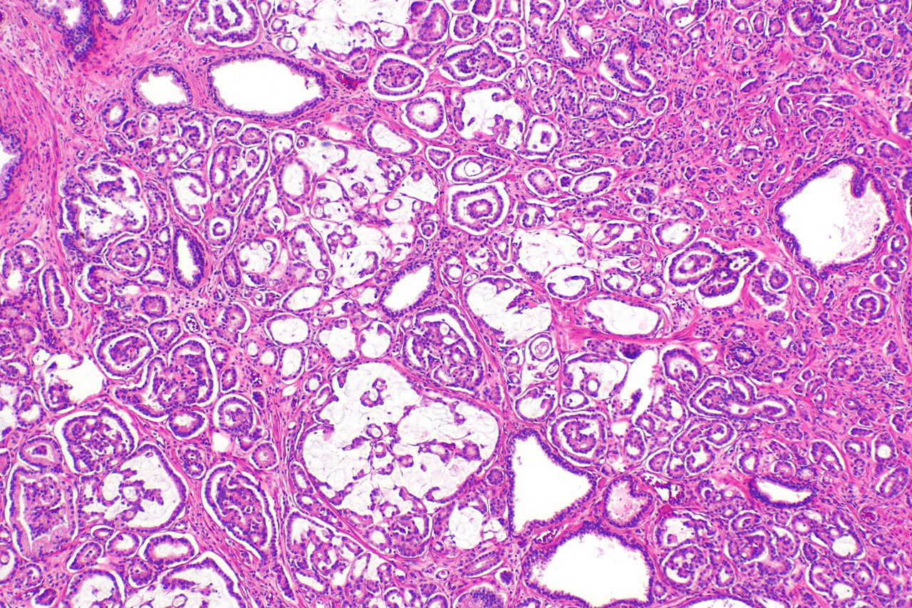 Micrograph showing mucinous adenocarcinoma of the prostate h
