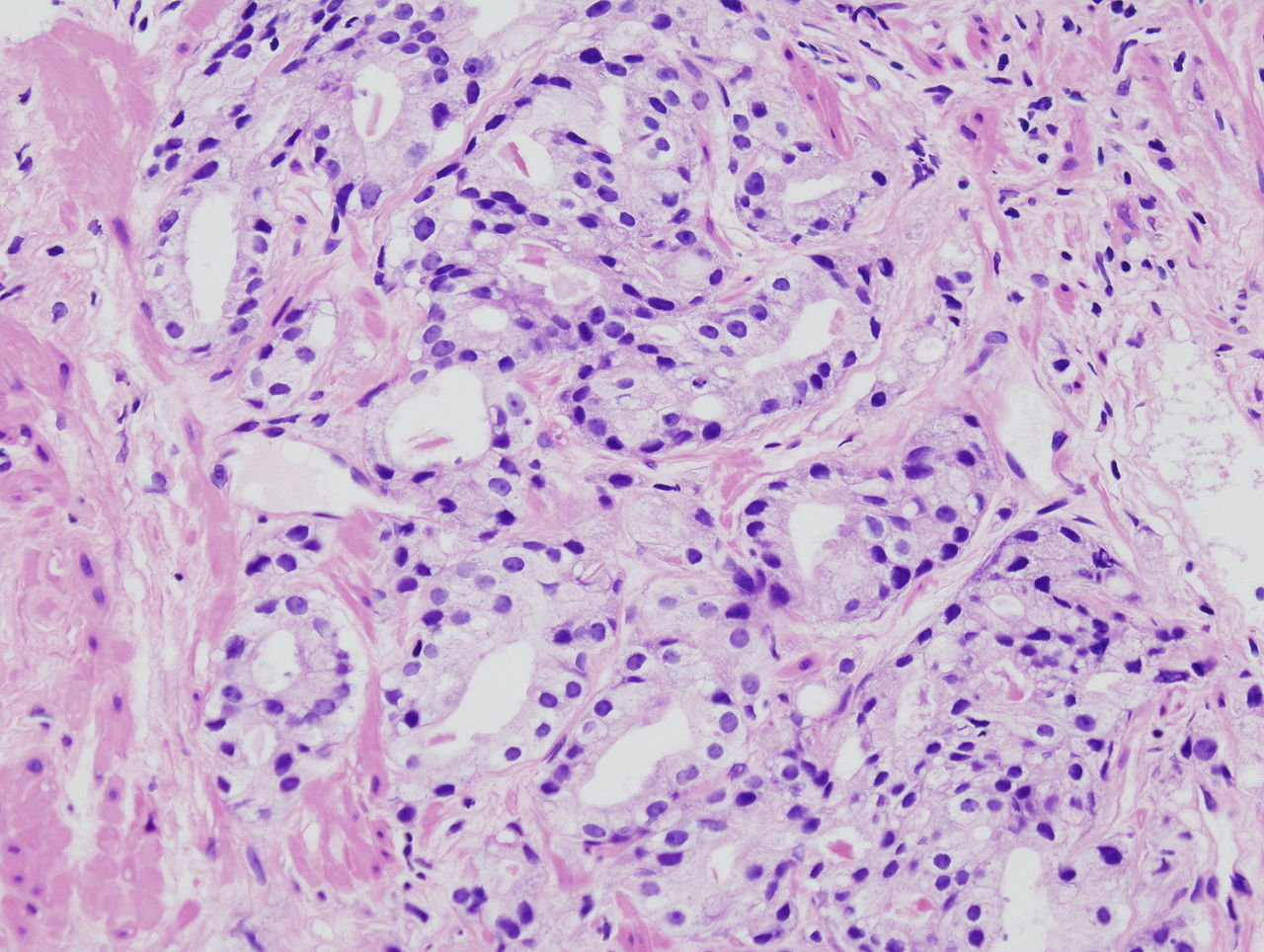 Histopathologic image of acinar type adenocarcinoma obtained