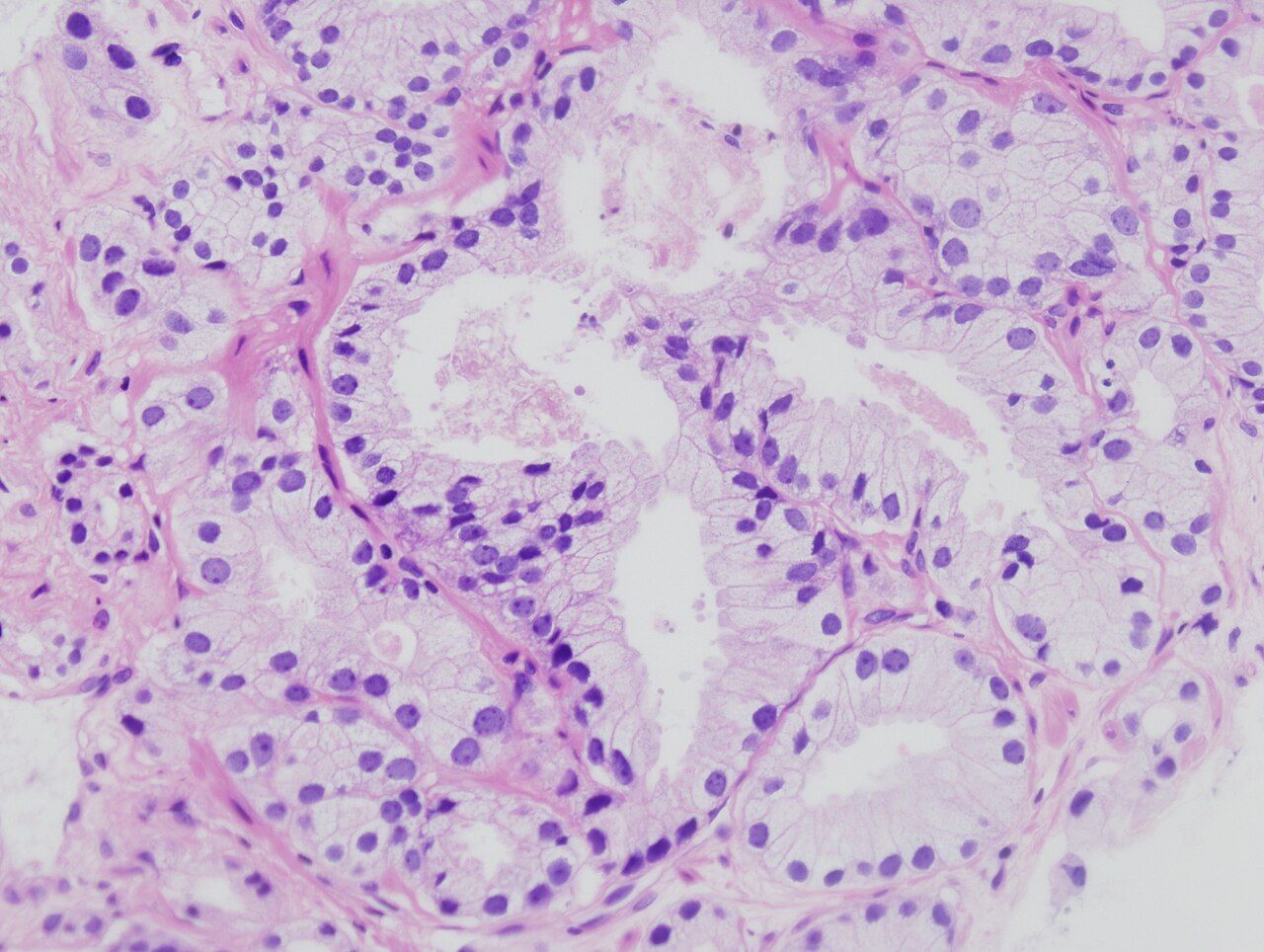Histopathologic image of acinar type adenocarcinoma obtained