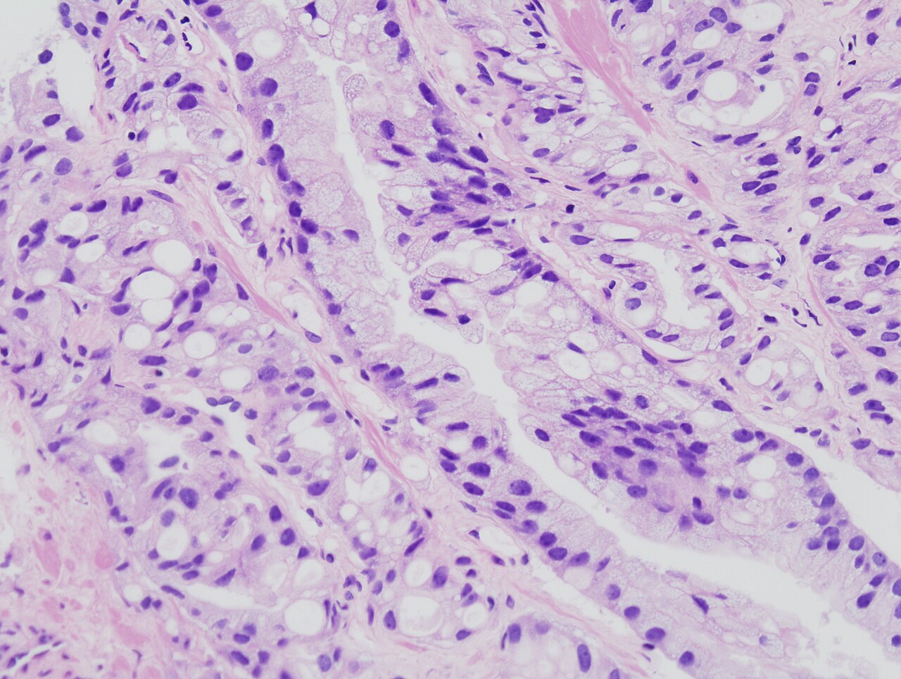 Histopathologic image of acinar type adenocarcinoma obtained