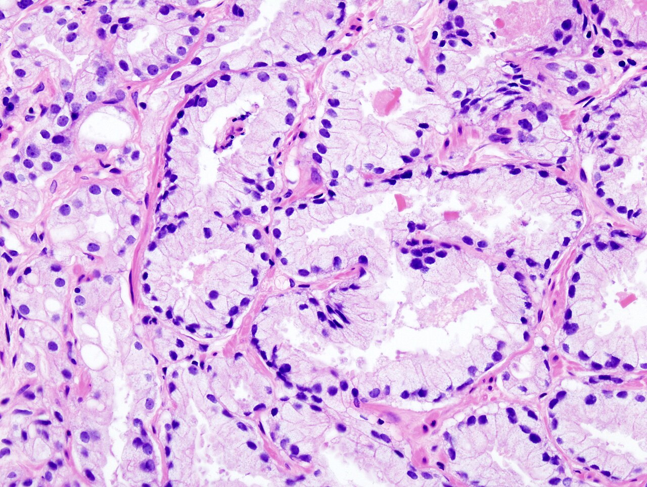 Histopathologic image of acinar type adenocarcinoma obtained