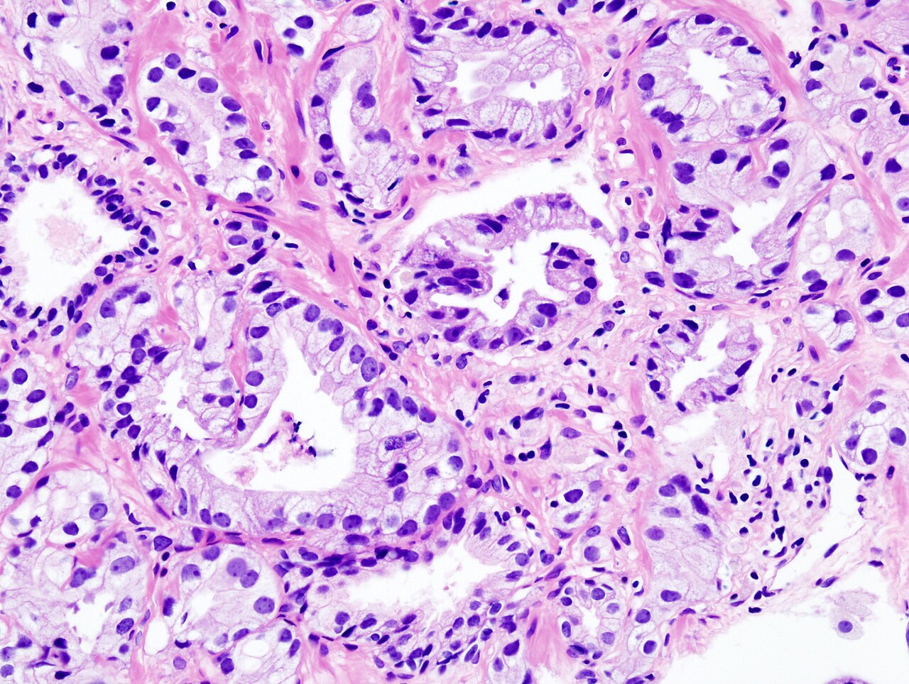 Histopathologic image of acinar type adenocarcinoma obtained