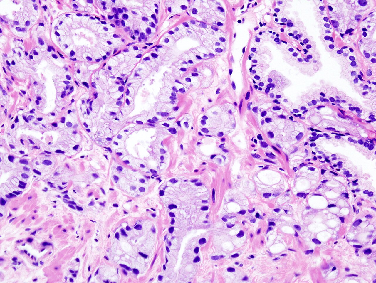 Prostate adenocarcinoma 6