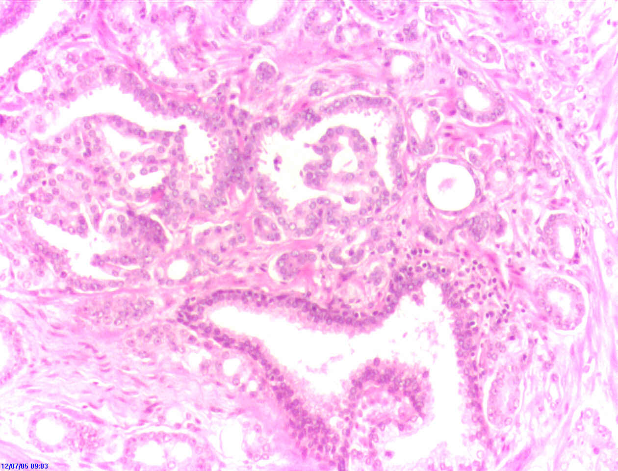 Microsopic view hematoxilin amp eosin 100x of abnormal tissu