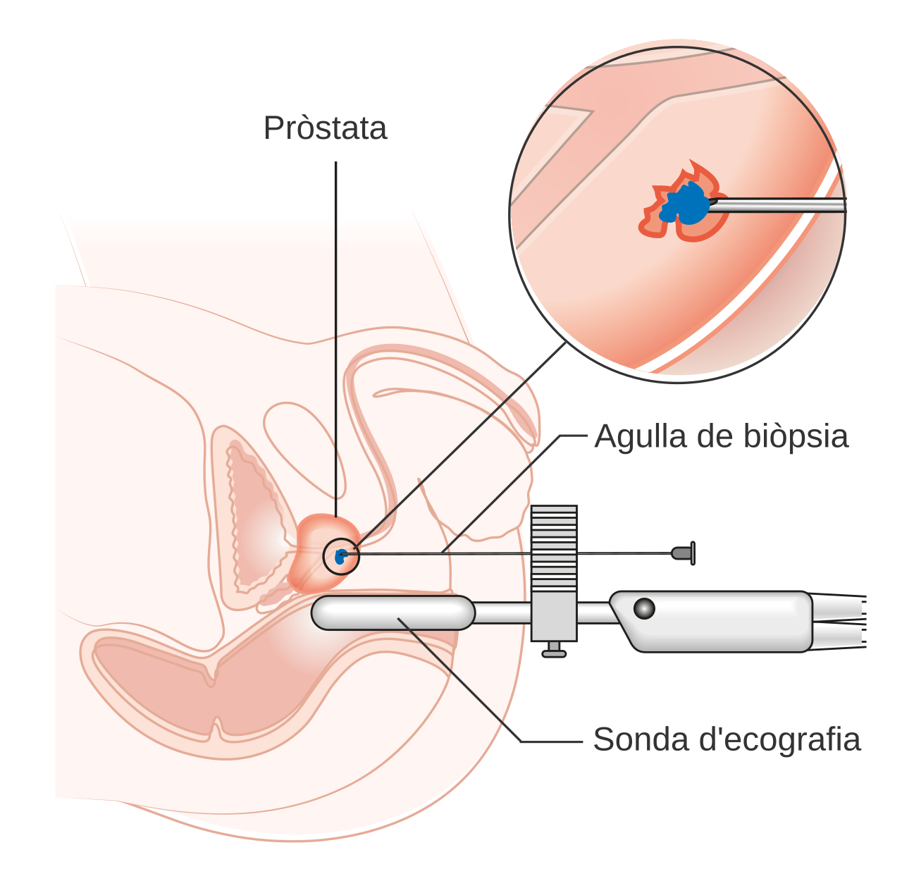 Esquema que mostra una bi psia transperineal de pr stata