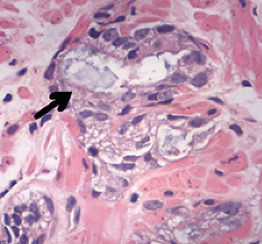 Micrograph of acinar adenocarcinoma of the prostate with blu