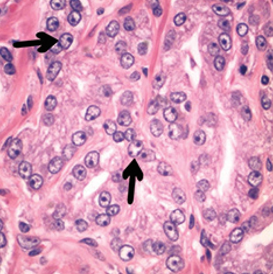 Micrograph of acinar adenocarcinoma of the prostate with dou