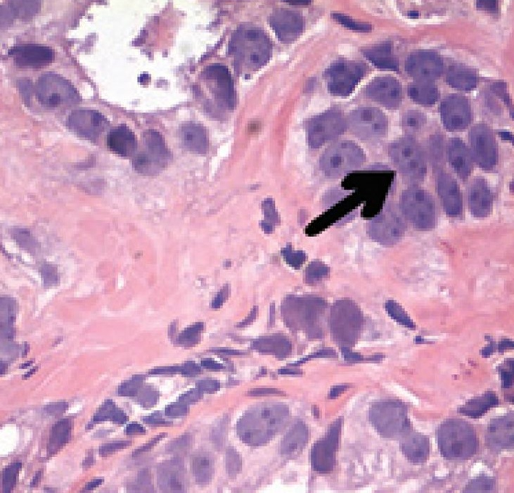 Micrograph of acinar adenocarcinoma of the prostate with mul