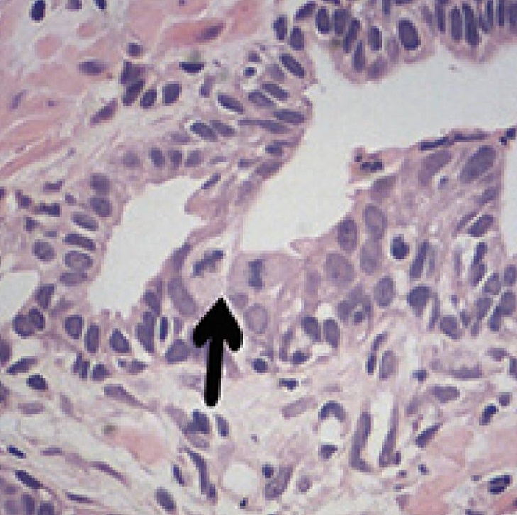 Micrograph of adenocarcinoma of the prostate with two mitose
