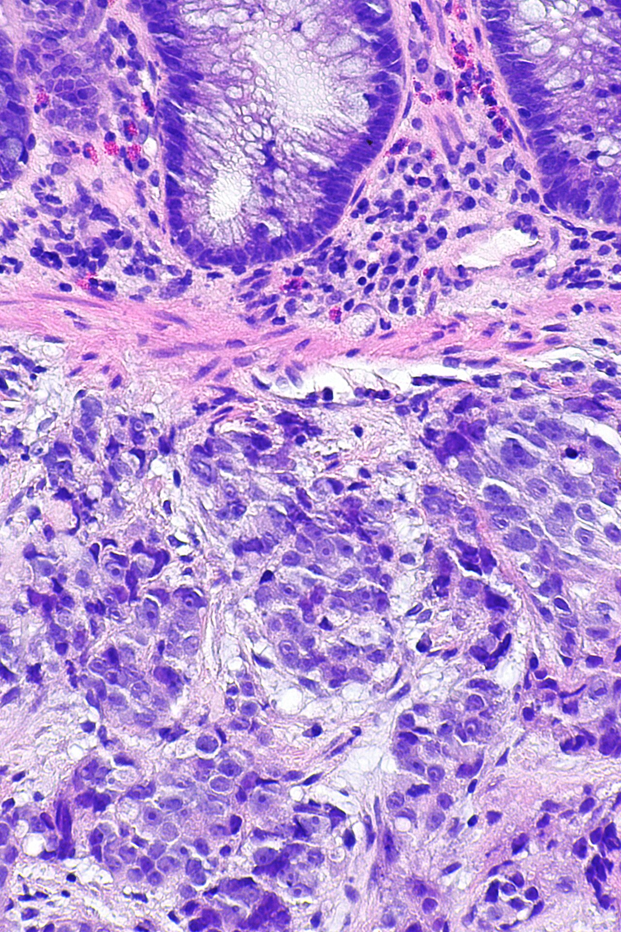 Micrograph showing a biopsy of the rectum with prostatic car