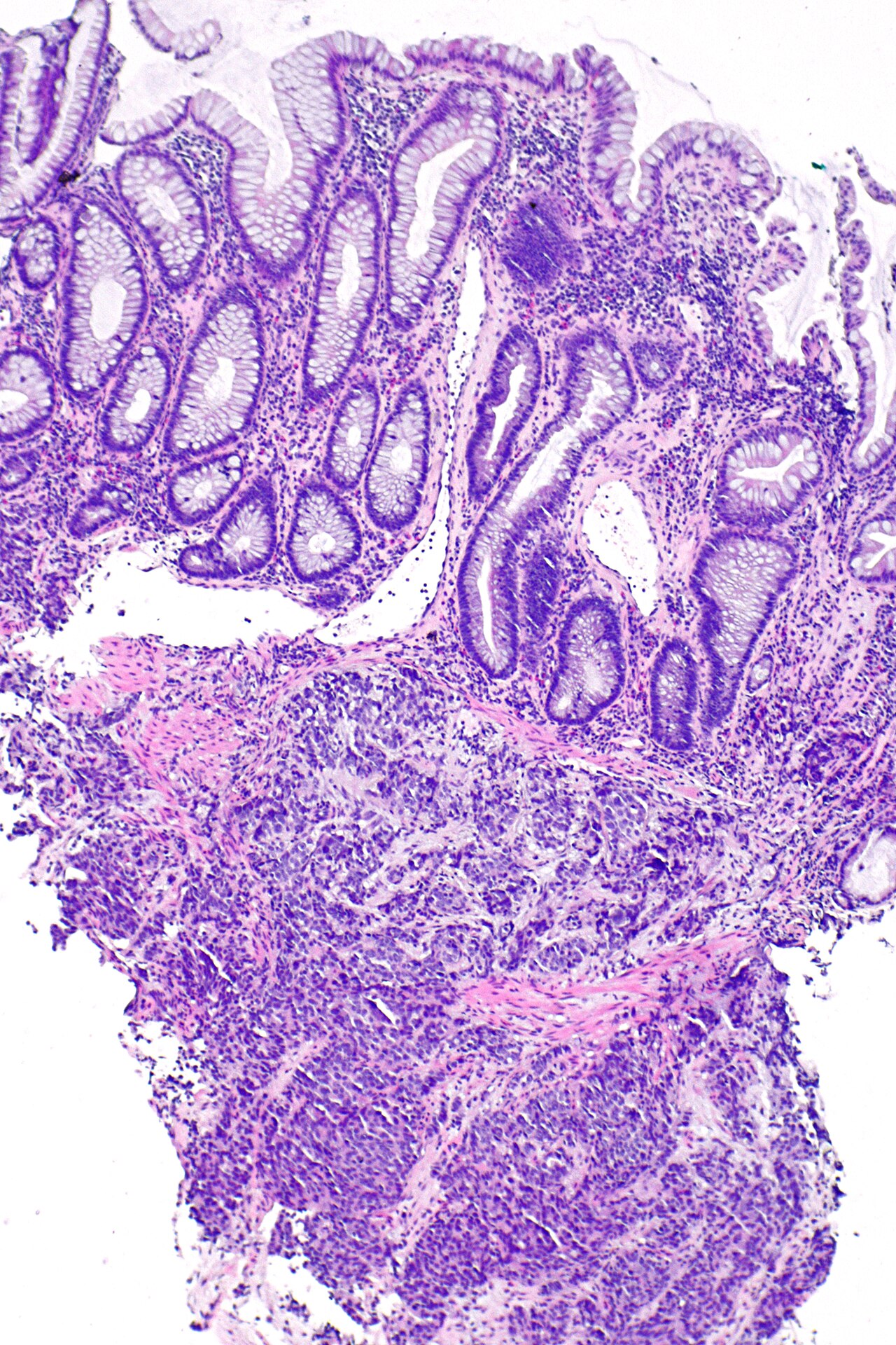 Micrograph showing a biopsy of the rectum with prostatic car