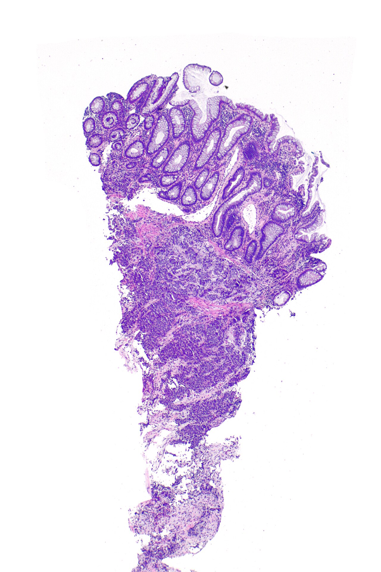Micrograph showing a biopsy of the rectum with prostatic car